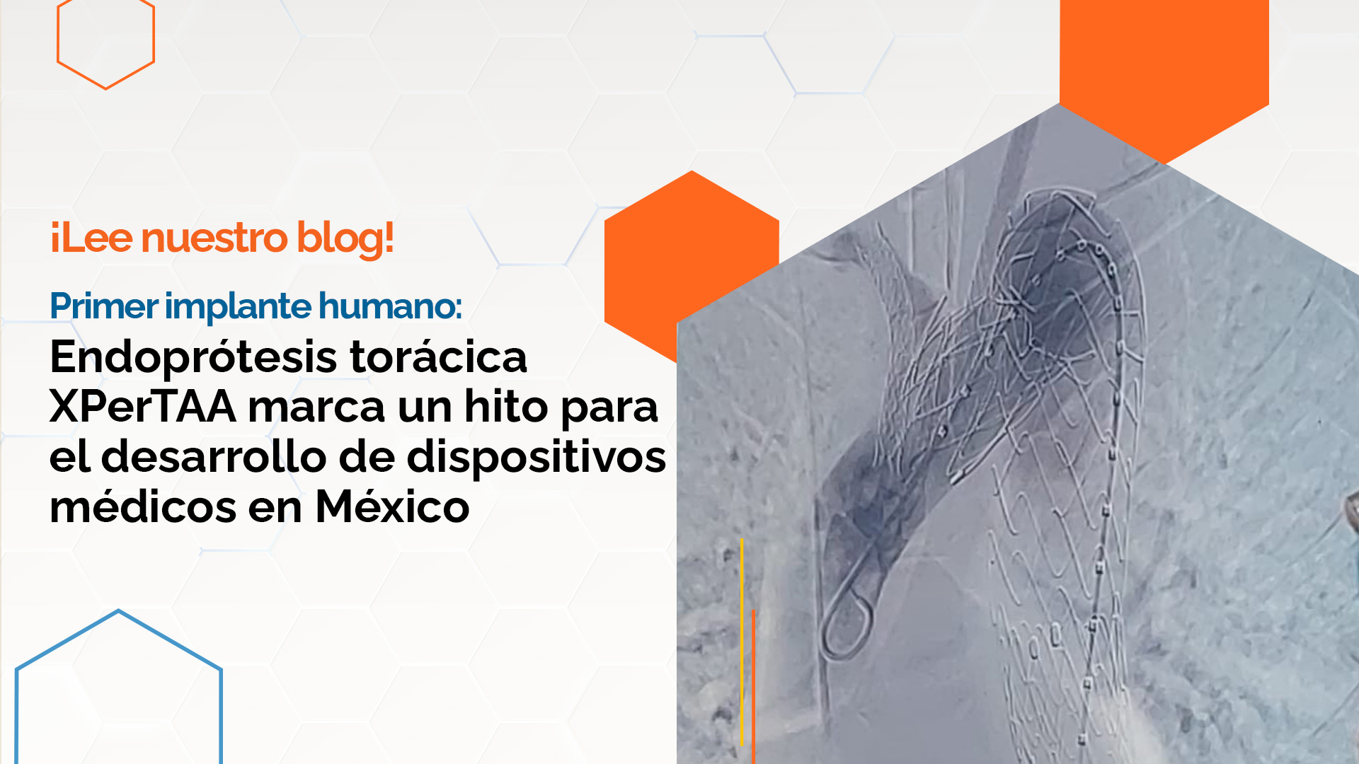 First human implant of XPerTAA thoracic endoprosthesis developed in Mexico